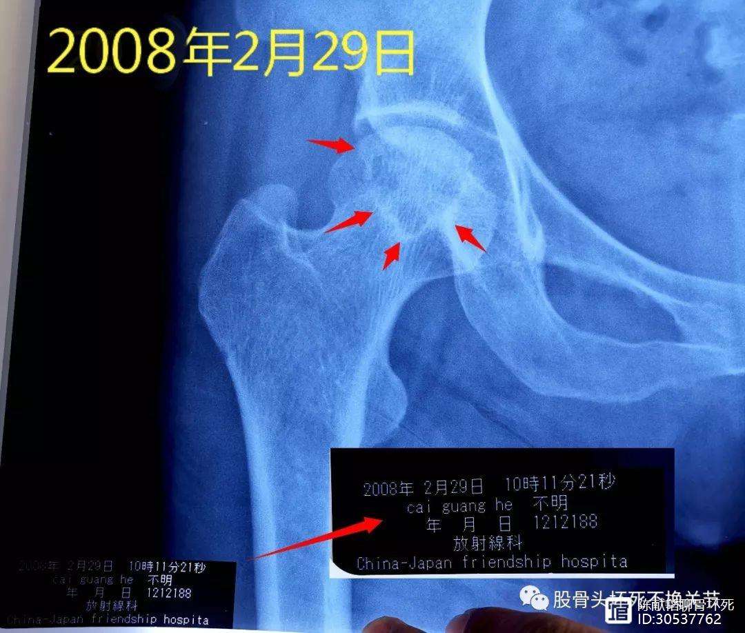 滁州人工骨头医保报销多少(人工骨头医保报销多少比例)